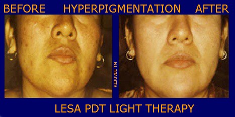 Hiperpigmetacion PDT Light Treatment