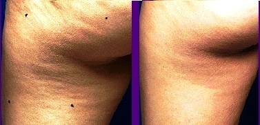 Mesotherapy RF Cellular Removal 