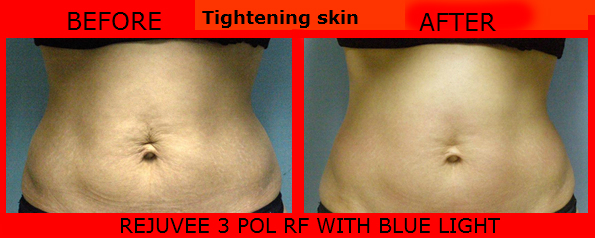Tightening skin 3 POLAR RF