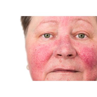 New PDL Device Safer And More Effective For Rosacea - Welcome to ...